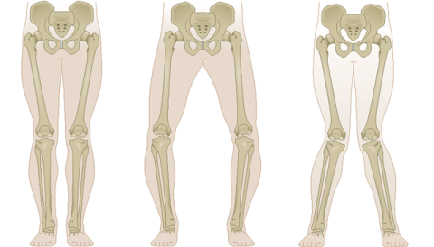 Ραιβογονία, Βλαισογονία, Πανδής Βασίλειος, Χειρούργος Ορθοπεδικός Τραυματιολόγος, Κέρκυρα