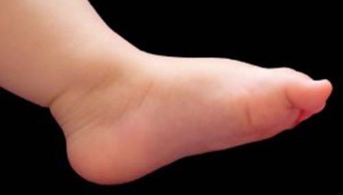 Πλατυποδία, Πανδής Βασίλειος, Χειρούργος Ορθοπεδικός Τραυματιολόγος, Κέρκυρα