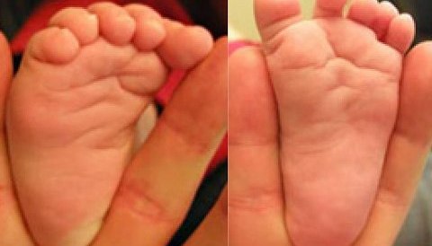 Έσω στροφή κάτω άκρων, Πανδής Βασίλειος, Χειρούργος Ορθοπεδικός Τραυματιολόγος, Κέρκυρα