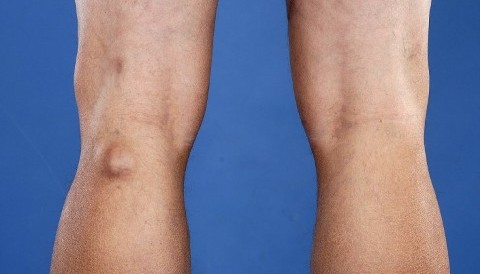 Ιγνυακή Κύστη, Πανδής Βασίλειος, Χειρούργος Ορθοπεδικός Τραυματιολόγος, Κέρκυρα